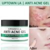 Anti Acne Gel-modernwears-pk-price-pakistan
