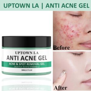 Anti Acne Gel-modernwears-pk-price-pakistan